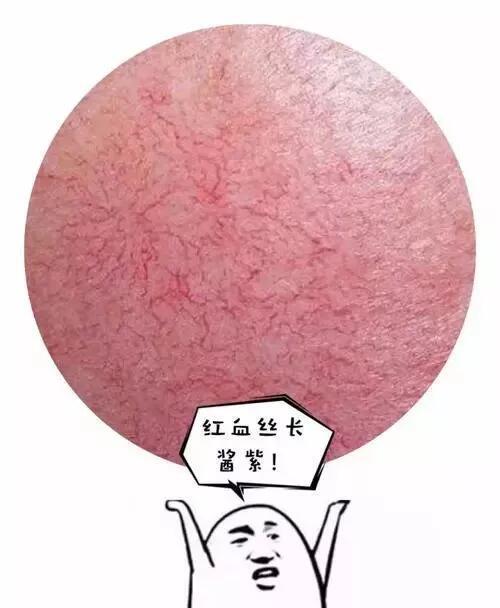 拯救红血丝